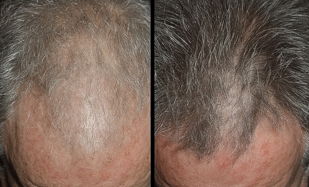 Minoxidil results timeline before and after