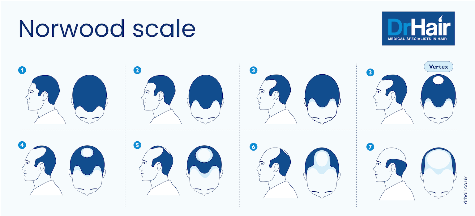 Stages Of Male Pattern Baldness The Norwood Scale DrHair