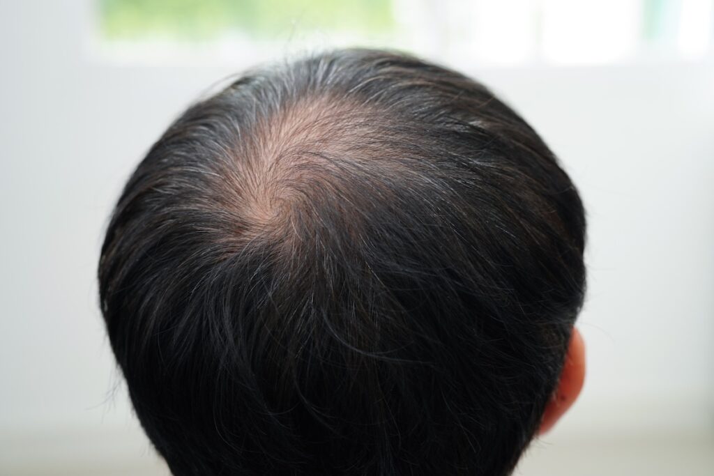 Stage 3 vertex hair loss