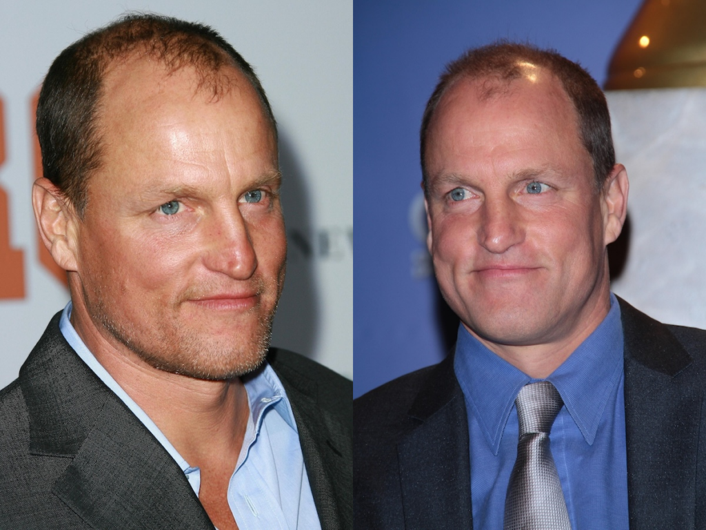 Woody Harrelson with stage 5 male pattern baldness