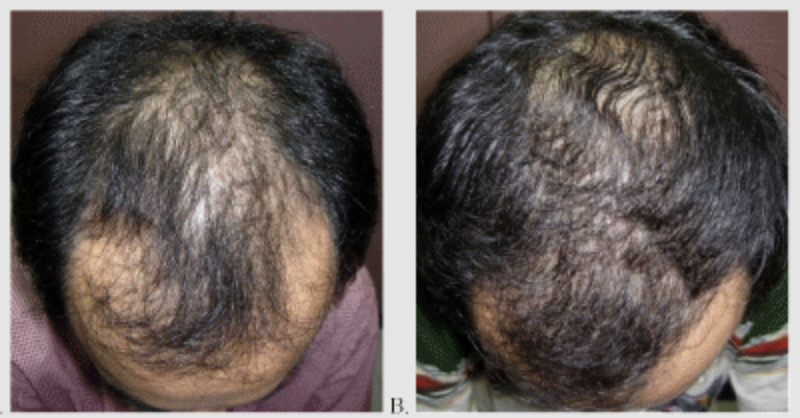 Finasteride results at baseline and after 1 year