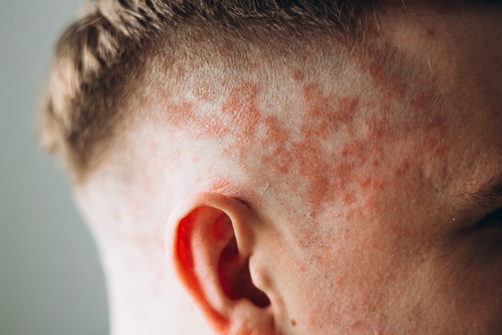 Man experiencing a minoxidil rash on the side of the head