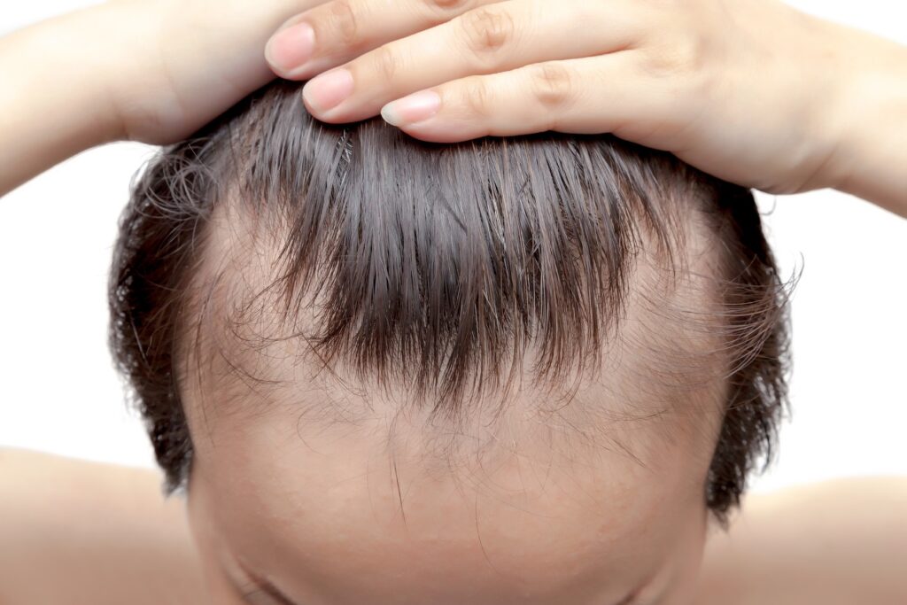 Man pulling hair back to reveal receding hairline