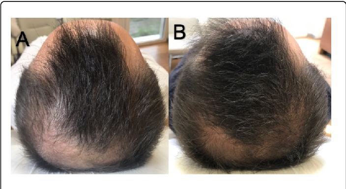 Minoxidil results at baseline and after 6 months