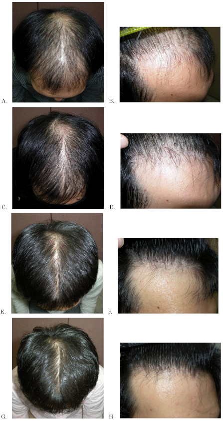 Progression of hair loss over 5 years of finasteride use