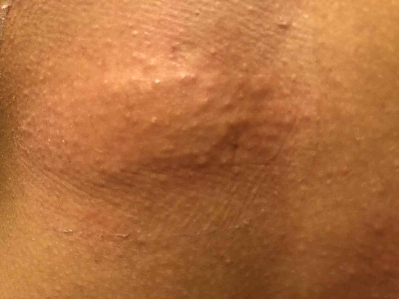 Raised minoxidil rash due to allergic contact dermatitis