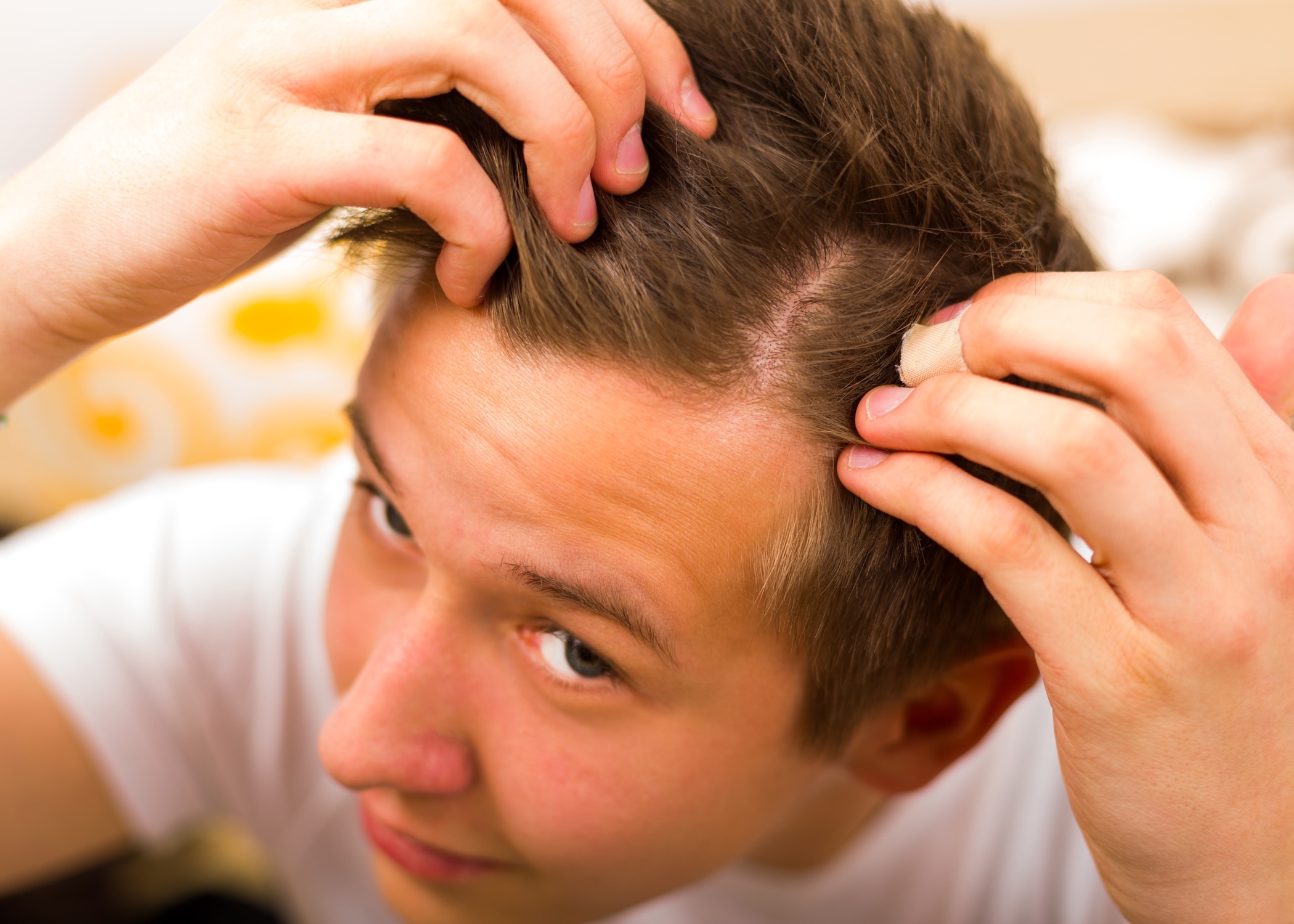 Temporary finasteride hair shedding