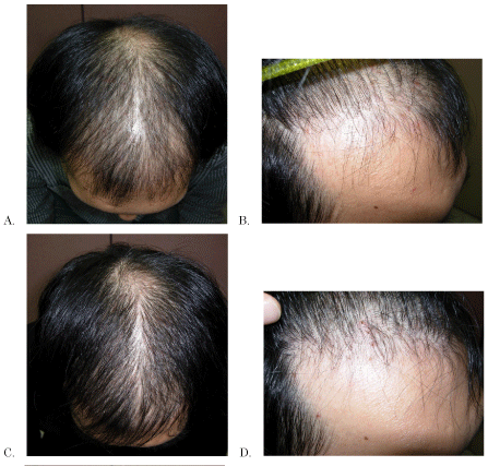 Before and after 24 weeks of 1 mg finasteride treatment