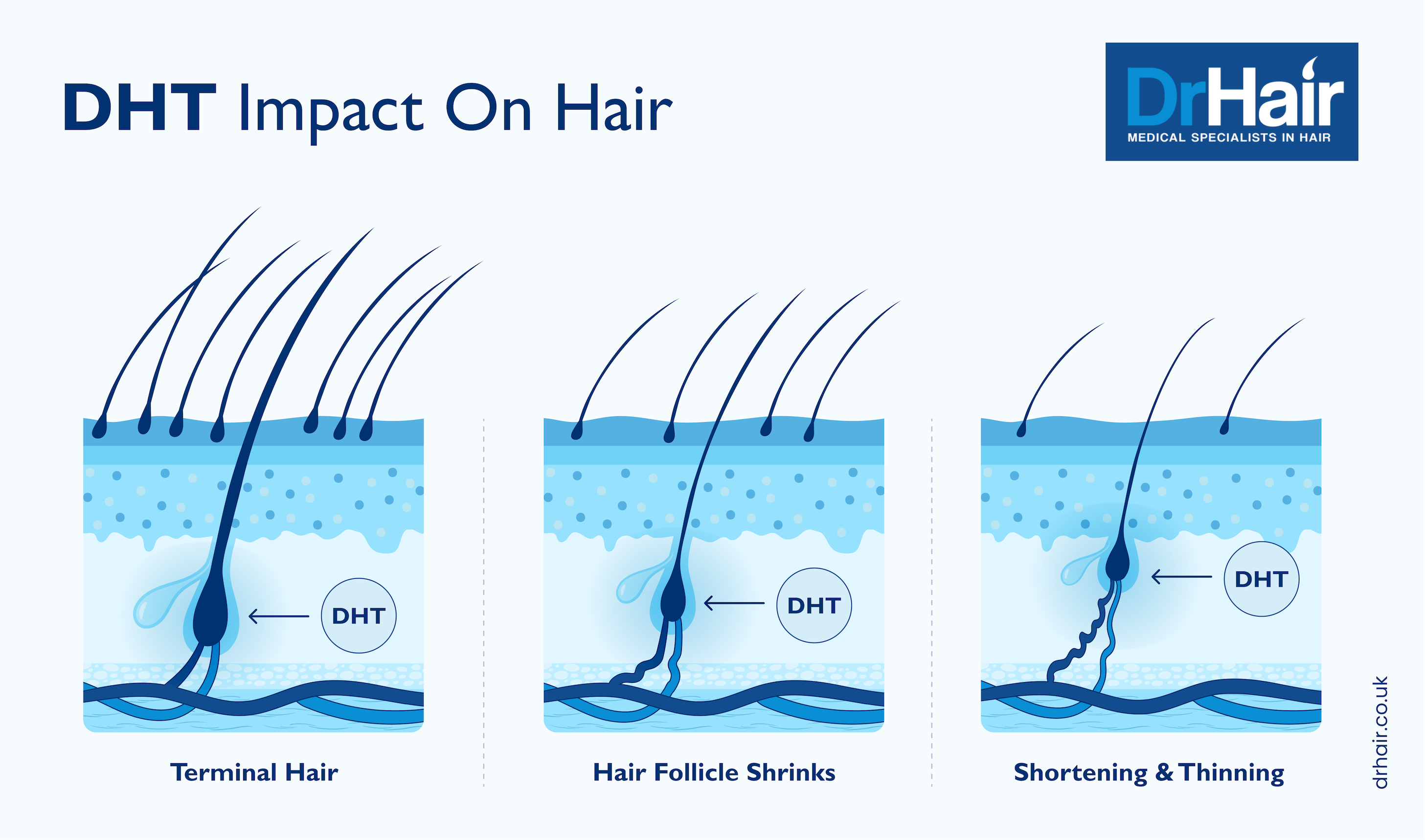 DHT impact on hair