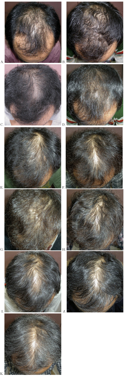 Hair growth progression from 0-10 years of finasteride use