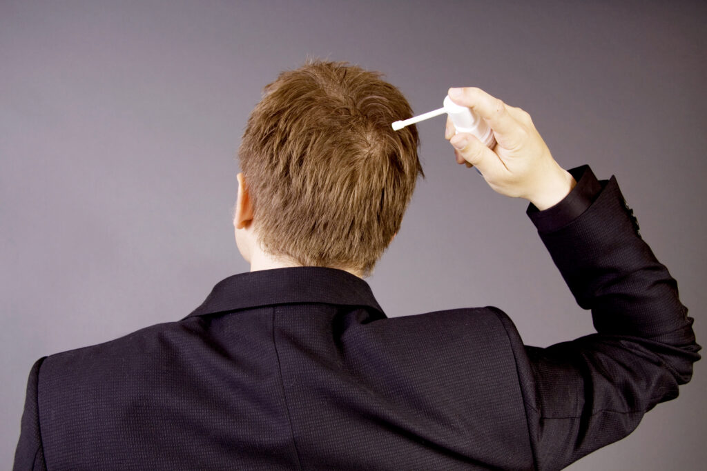 Man applying azelaic acid for hair combined with minoxidil