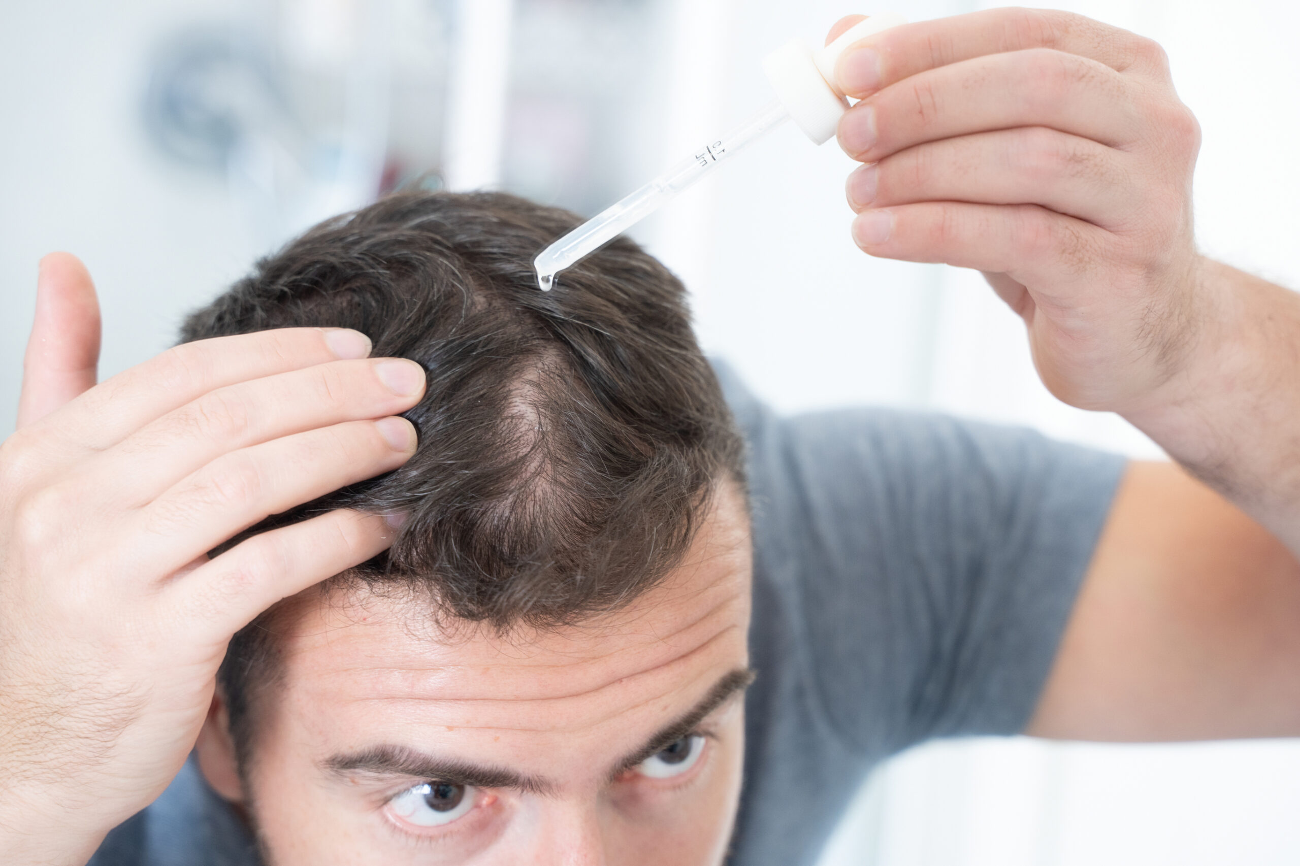 Man applying topical finasteride