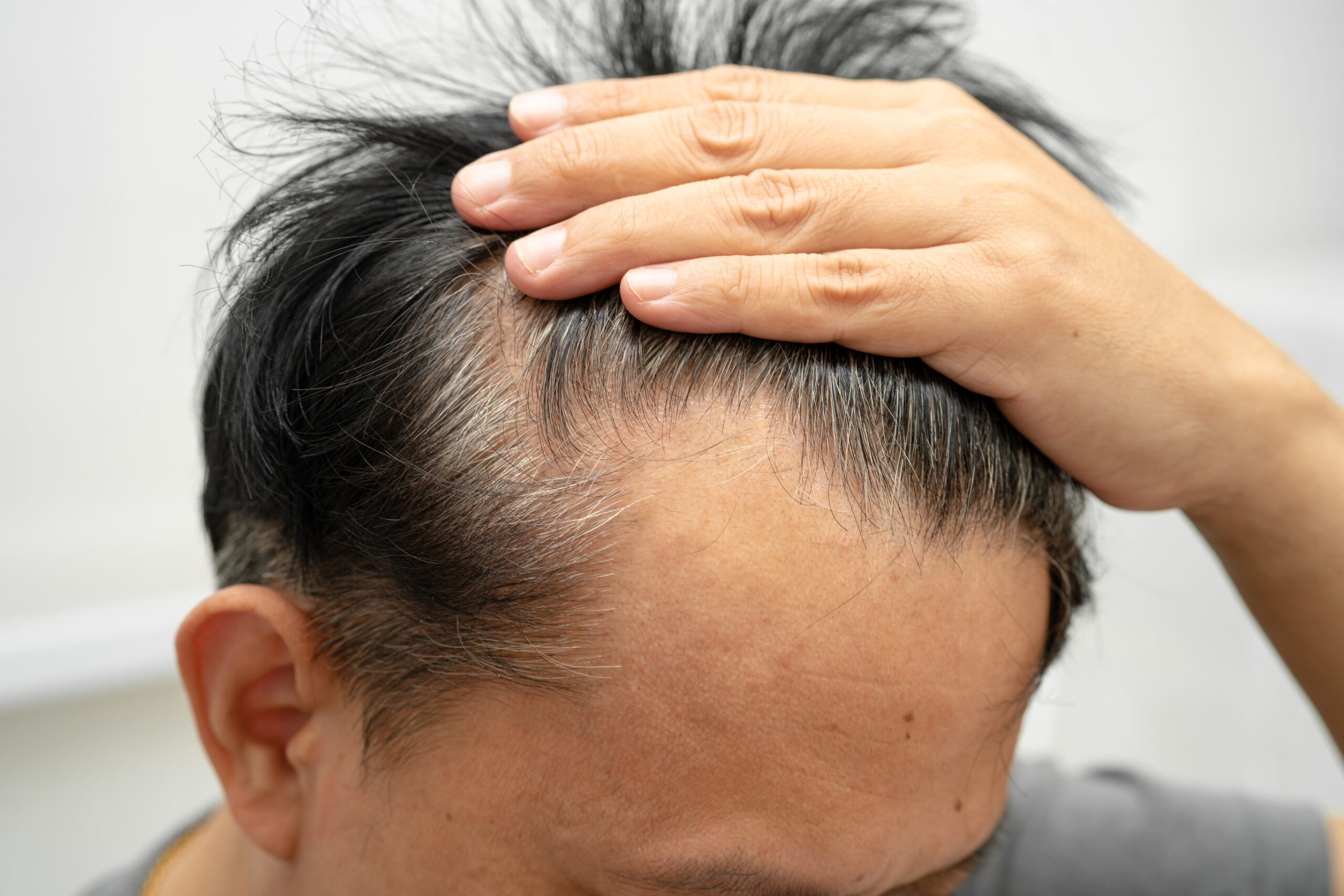 Man pulling back hairline to show balding