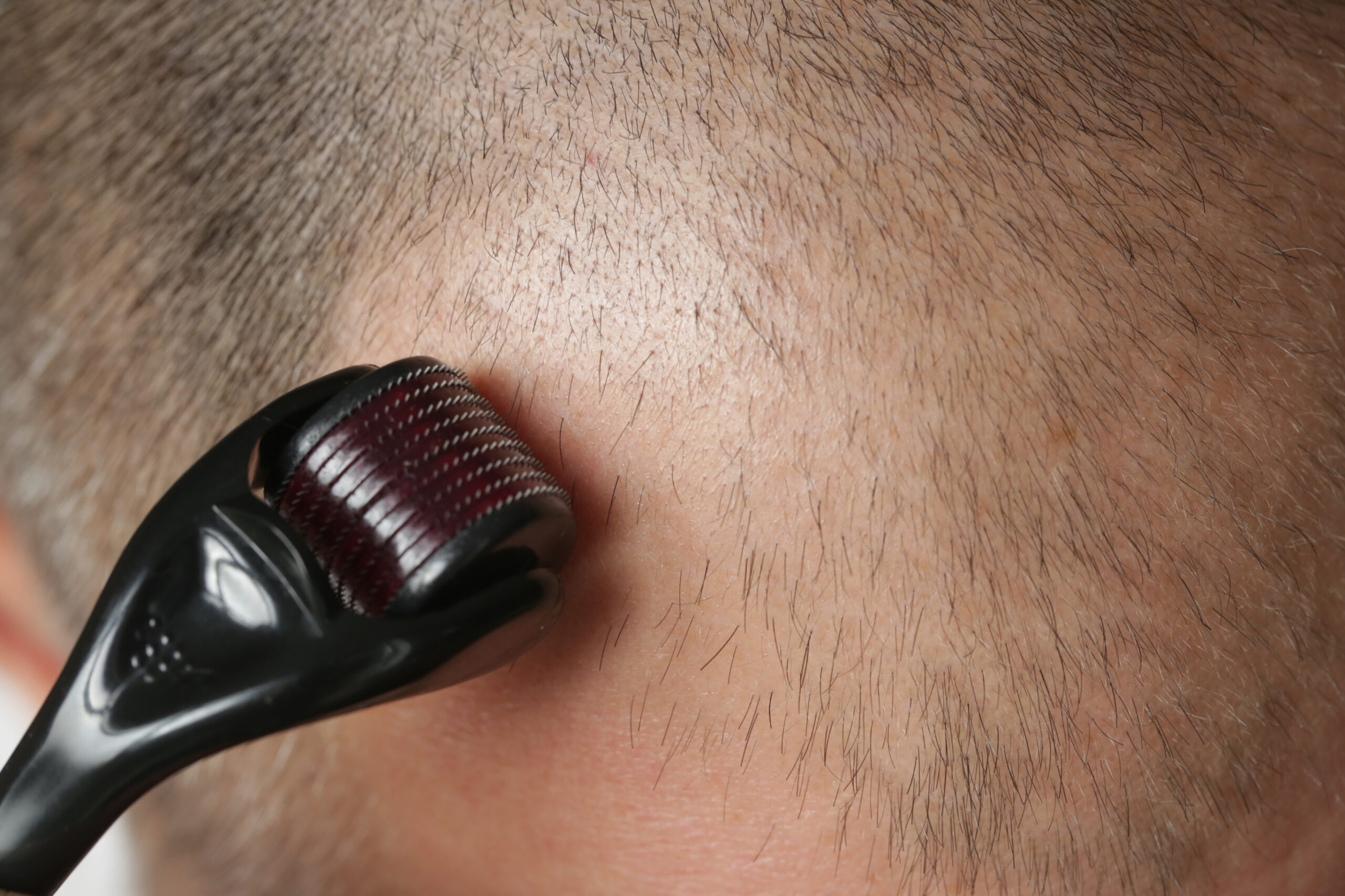 Man using a derma roller with minoxidil on receding hairline