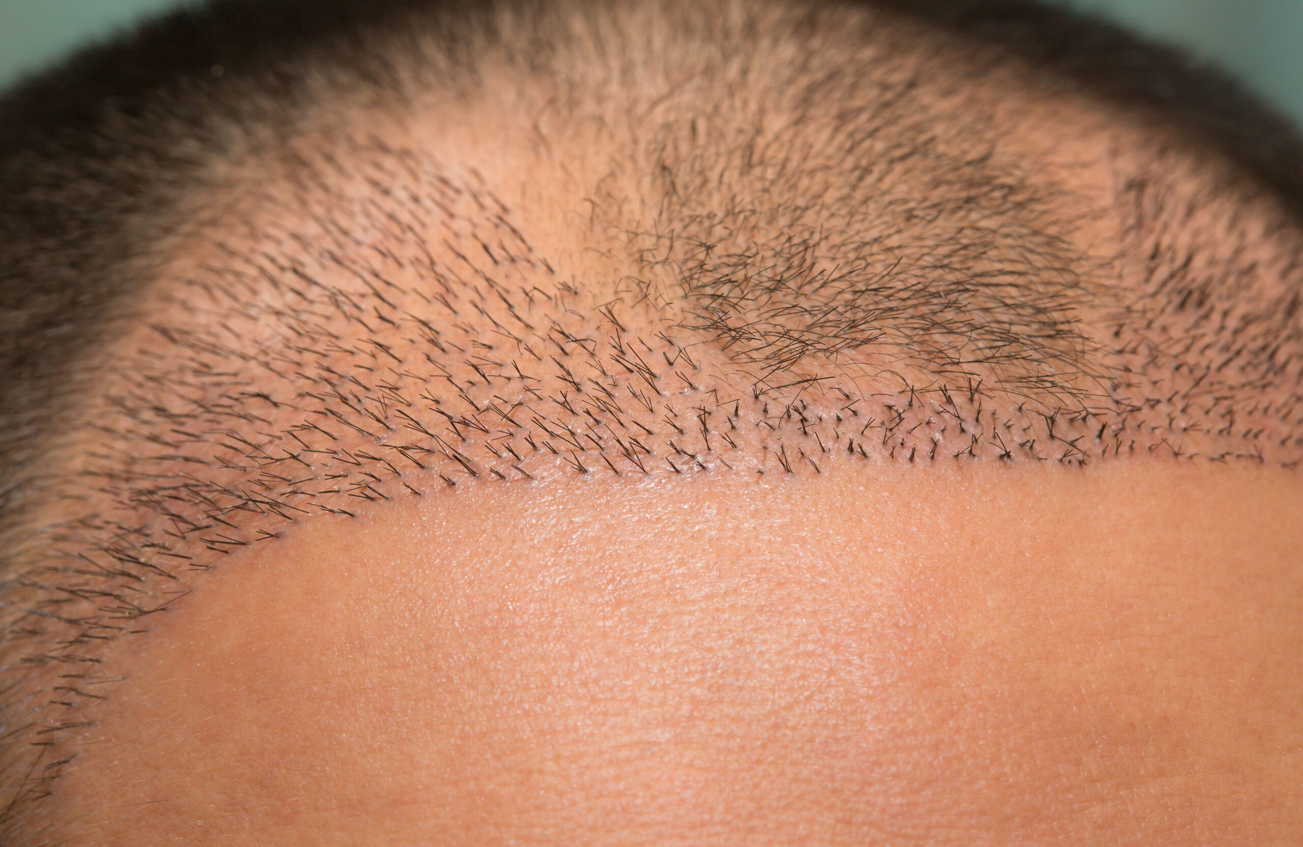 Man with new growth after hair transplant