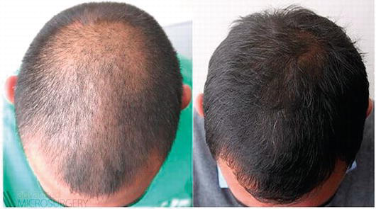 Minoxidil results 