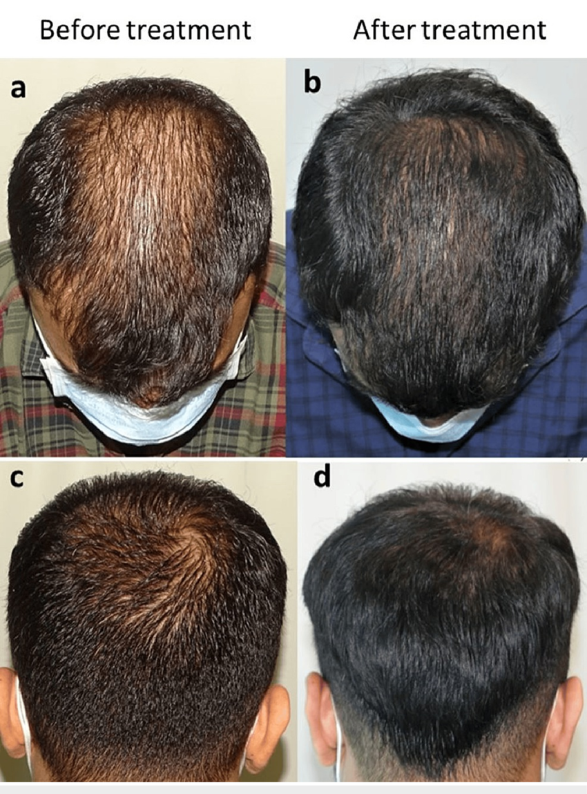 Results from cetosomal minoxidil after 16 weeks 