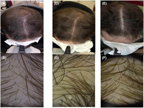 combined finasteride and minoxidil results