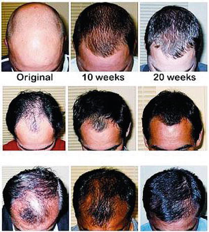 finasteride results in 3 different patients