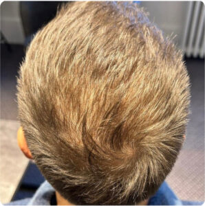 Jacob’s finasteride results before and after