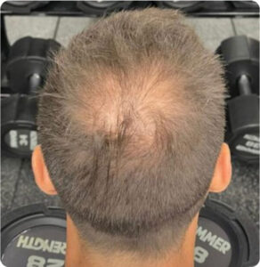 Jacob’s finasteride results before and after