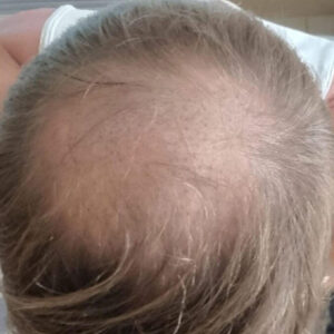 Michael's finasteride & hair transplant results