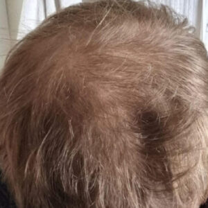 Michael’s finasteride & hair transplant results