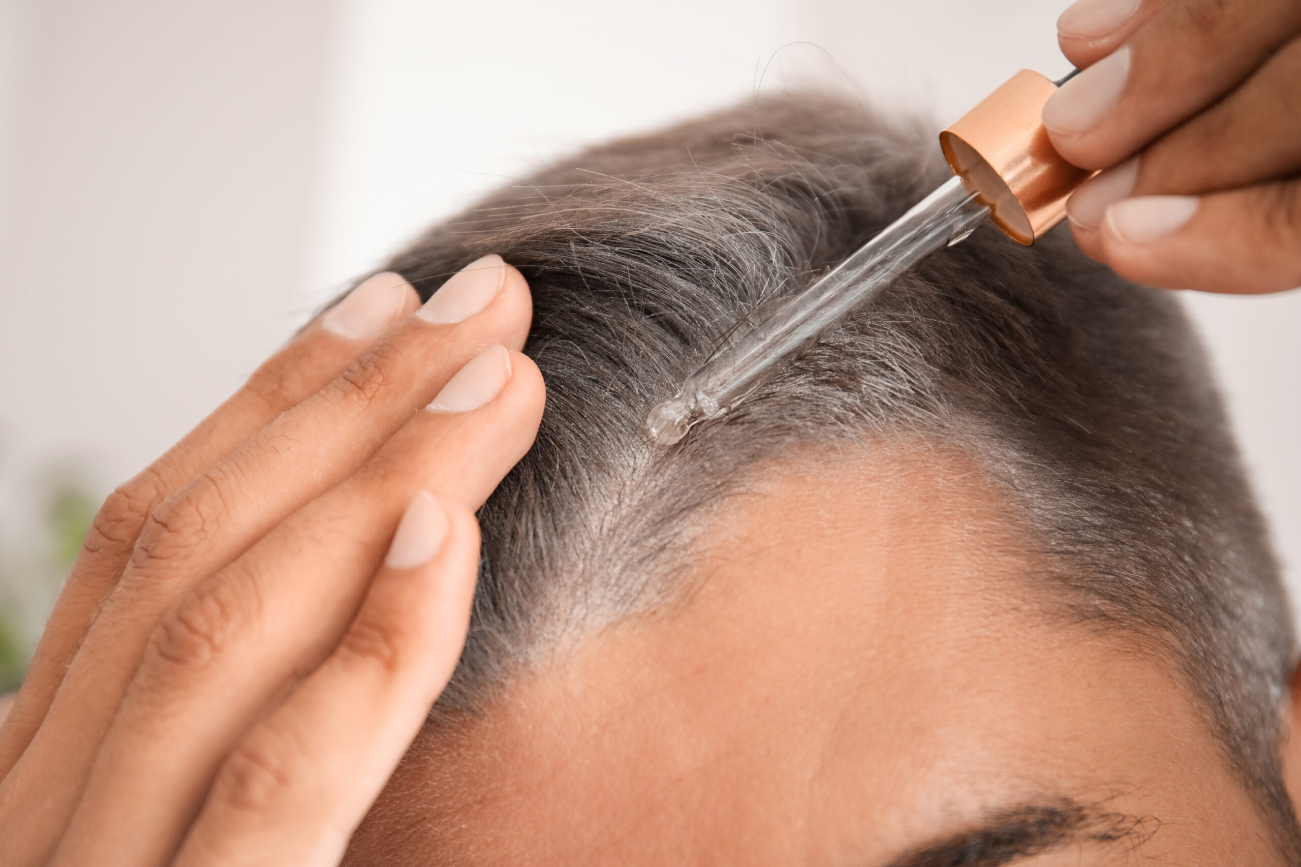 man using topical finasteride to prevent side effects