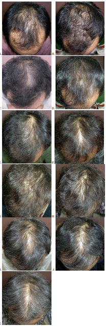 Hair growth progression from 0-10 years of finasteride use. Source: [11].